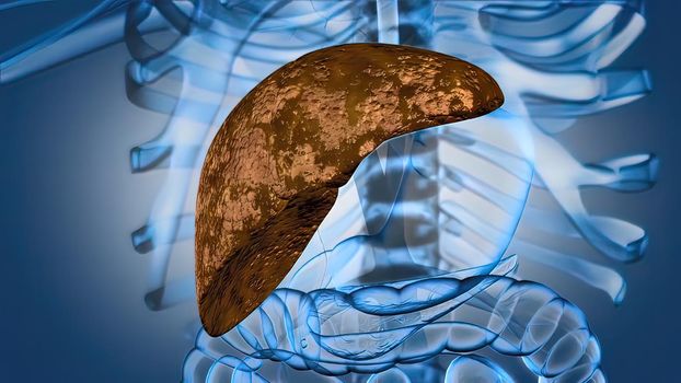 The Progression of Liver Disease. Liver failure