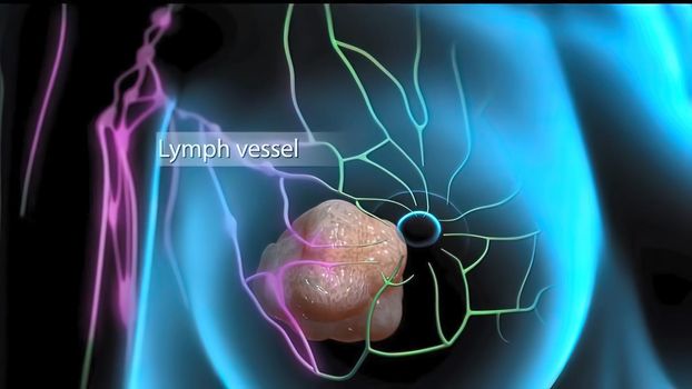 Interaction of tumor cells and lymphatic vessels in cancer