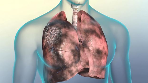 Human respiratory system.Lungs damaged by smoking