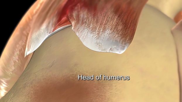 The humeral head is the articular surface of the upper extremity, which is hemispherical.