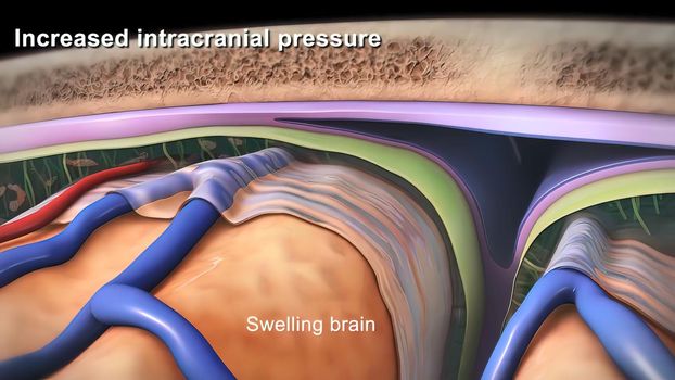 Increased intracranial pressure, brain damage and spinal cord injury