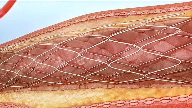 Angioplasty and Vascular Stenting