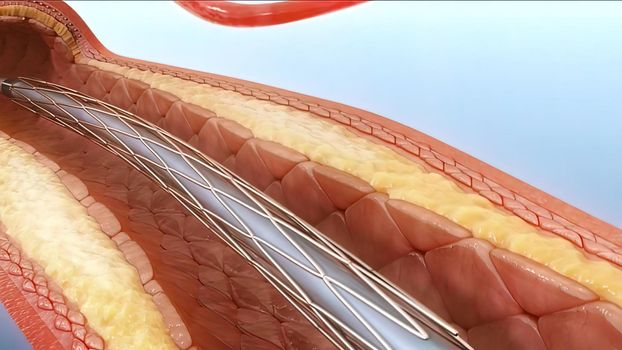 Angioplasty and Vascular Stenting