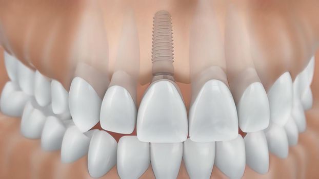 Dental implant surgery.