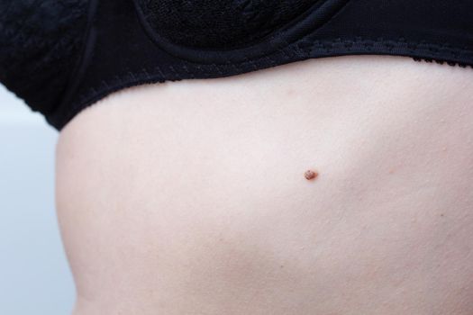 Birthmark on woman body