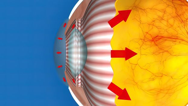 3D Medical Animated Normal Tension Glaucoma on Blue Background