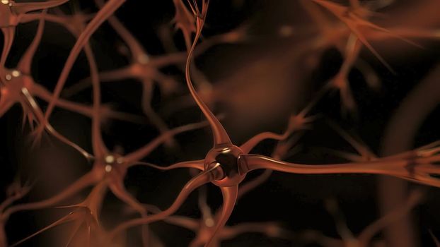Neurons With Amyloid Plaques,