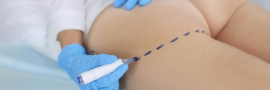 Surgeon drawing marks on female body before plastic operation