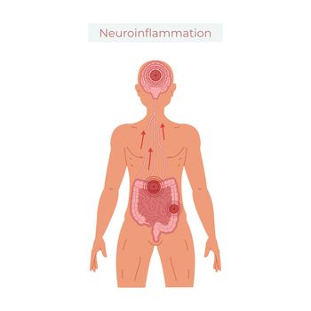 Poor gut health leads to neuroinflammation vector illustration.