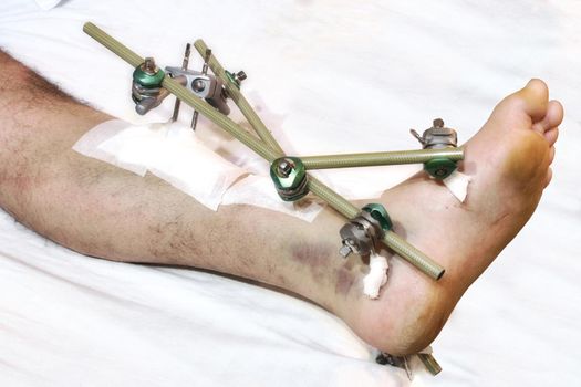 A man's leg with orthopaedic metal rods forming a fixed brace