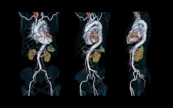 CTA Whole aorta 3D rendering image on black background for detect aortic aneurysm.