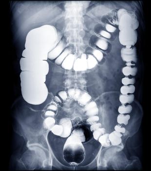Selective Focus of barium enema image or x-ray image of large intestine 