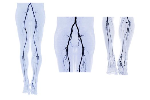 Collection of CTA femoral artery run off  3D MIP image.