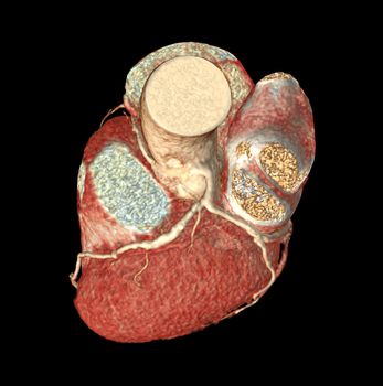 Top view of CTA Coronary artery  3D rendering image isolated o black backgroud for finding coronary artery disease.Clipping path.