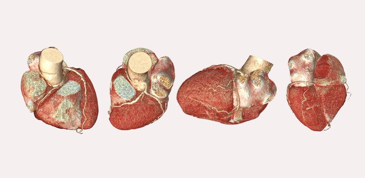 Collection of CTA Coronary artery  3D 