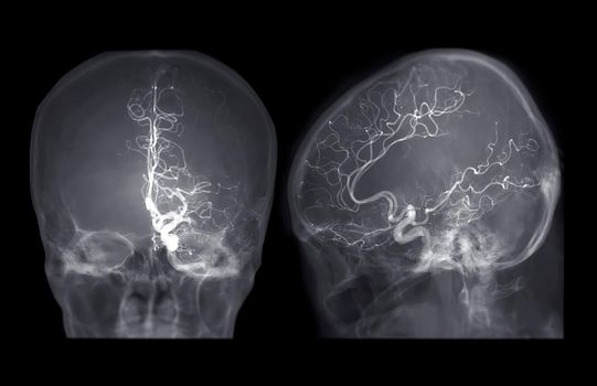 Cerebral angiography AP and Lateral  view image from Fluoroscopy in intervention radiology  showing cerebral artery.