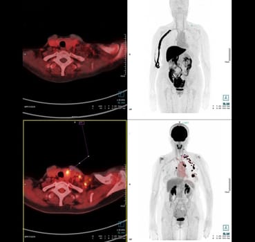 PET Scan image of thorax or chest  Comparison Axial , Coronal  for detect lung cancer recurrence after surgery. medical technology concept.