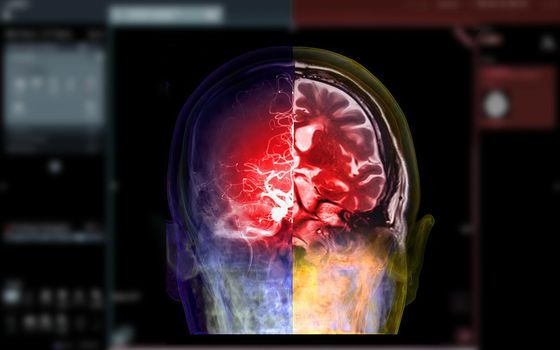 CTA brain and mri brain fusion image . medical technology concept.