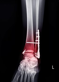X -ray ankle with Plate and screw