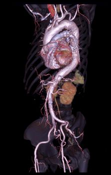CTA abdominal aorta 3D rendering image  on transparent skeletal .