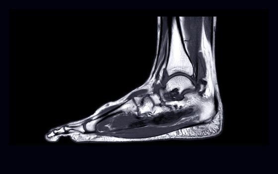 MRI FOOT Sagittal T2  for diagnostic tendon injury.