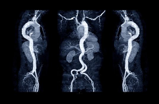 Collection of CTA whoe aorta with curve MPR technique showing abdominal aorta and left, right iliac artery showing aortic dissection .