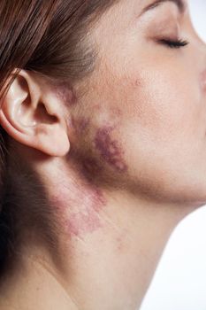 woman with real port wine stain birthmark on her face,