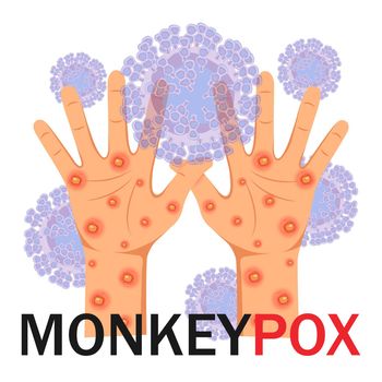 Monkeypox virus. Human hands with a rash