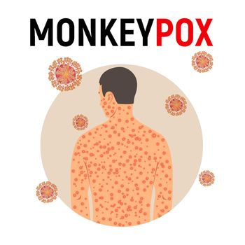 Man sick with monkey smallpox in flat style