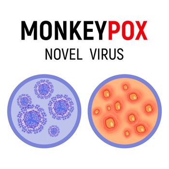 Monkeypox virus cells and human skin with rash