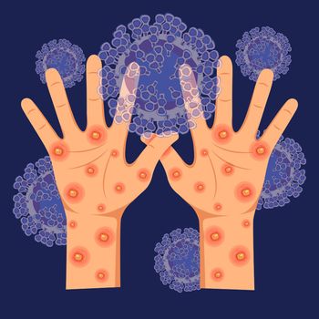 Human hands with monkeypox virus