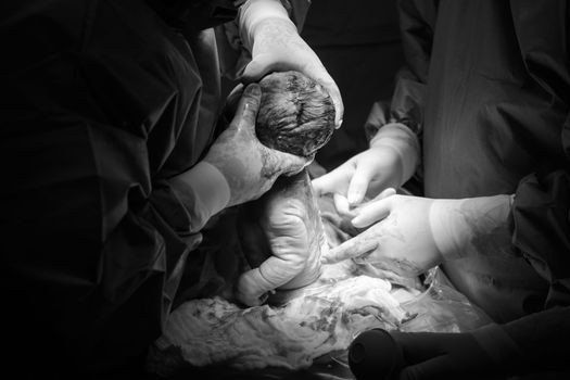 Cesarean section the operation is in process.