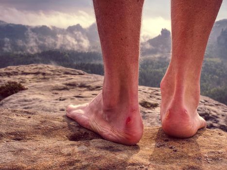 Big bloody callus on man heel.   Sandstone rock with hikers legs 
