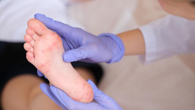 Rash with enterovirus infection of picornavirus family on feet of child