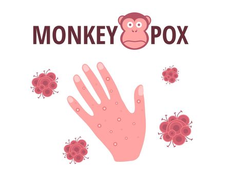 Monkey pox virus. Vector design with skin rash on the hand, symptom of an infectious disease