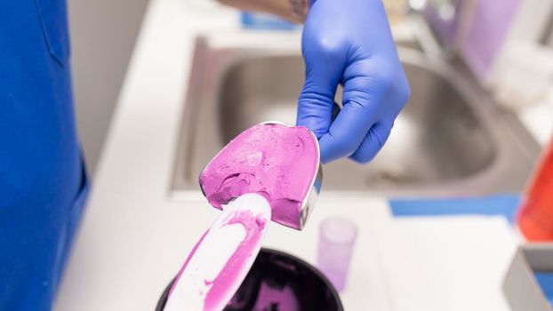 Close up of a female dentist's hands placing purple compound into an impression tray at the dental clinic