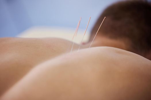 My back has been acting up lately. a man using acupuncture needles.
