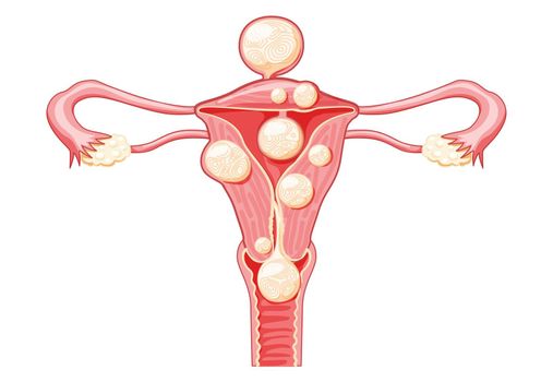 Uterine fibroids Female leiomyomas reproductive system uterus. Front view. Human anatomy medical illustration isolated
