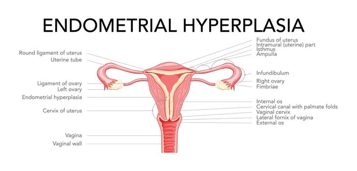 Endometrial hyperplasia Female reproductive system uterus with inscriptions medical diagram. Front view in a cut.