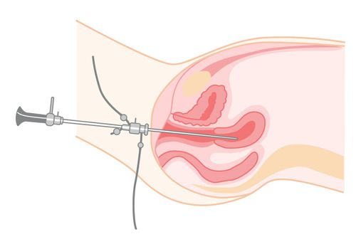 Hysteroscopy of Female reproductive system treat examine Diagnostic uterus. Side view in a cut. Human anatomy internal