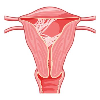 Asherman syndrome Female reproductive system scar tissue adhesions in uterus. Front view in a cut. Human anatomy organs