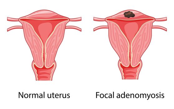 Focal Adenomyosis Human anatomy Female reproductive system diagram with text Sick and normal organ uterus vagina icon