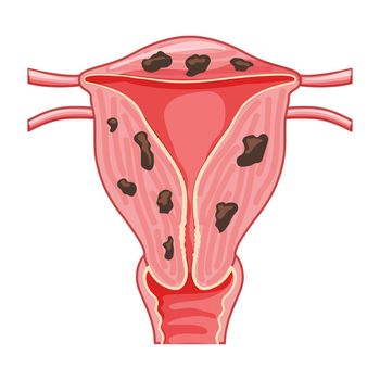 Adenomyosis Focal cancer Human anatomy Female reproductive Sick system organs icon. vector medical illustration.