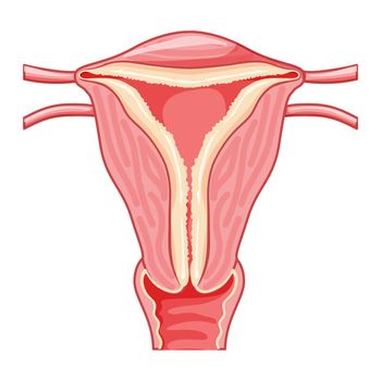 Set of Endometrial hyperplasia Female reproductive system uterus with thick endometrium layer. Front view in a cut