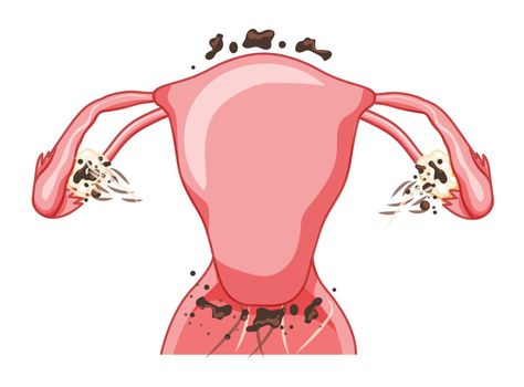 Endometriosis 3 stage Female reproductive system Front view. Human anatomy internal organs scheme, cervix, ovary