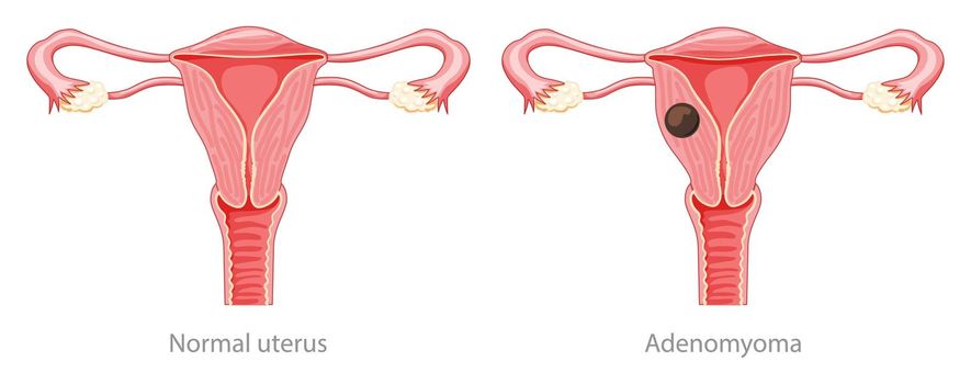 Adenomyoma Adenomyosis Human anatomy Female Sick and normal reproductive system organs. Location scheme Cross section uterus, cervix, ovary, fallopian tube icon. Vector illustration isolated on white