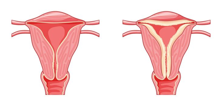 Set of Endometrial hyperplasia Female reproductive system in normal and problem uterus. Front view in a cut. Human
