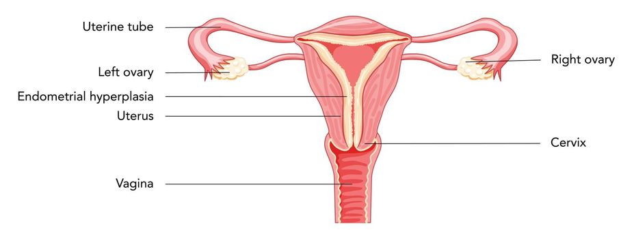 Endometrial hyperplasia Female reproductive system uterus in different styles diagram with inscriptions text Front view