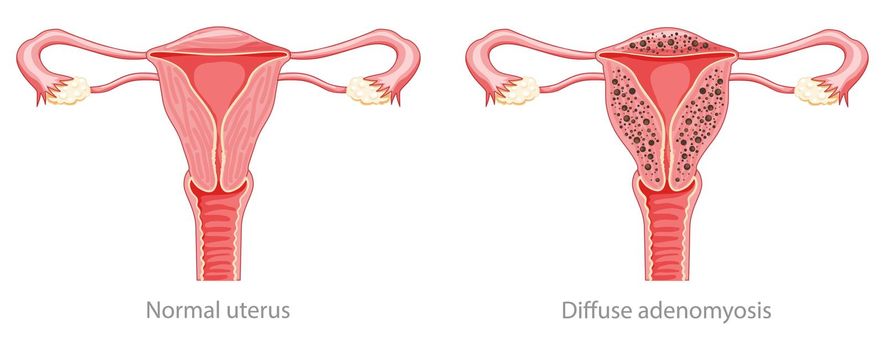 Diffuse Adenomyosis Human anatomy Female Sick and normal reproductive system organs. Location scheme Cross section