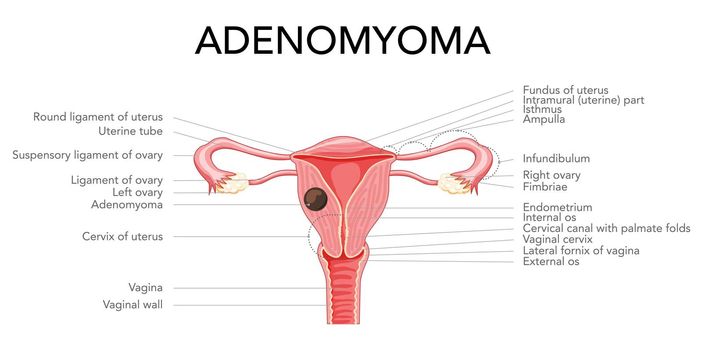 Adenomyoma Adenomyosis with inscriptions, Human anatomy Female reproductive Sick system organs. Structure of uterus